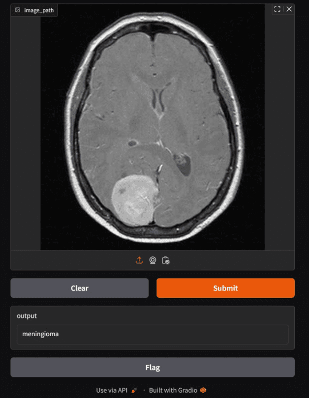 Real Brain Tumor Detection Gradio application screenshot showing an MRI image classified as meningioma.